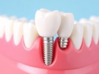 Caring for Dental Implants Prevent Peri-Implantitis