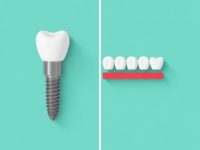 Dental Implants vs Bridges