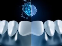 Fluoride vs. Nano-Hydroxyapatite A Clinical Comparison
