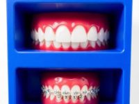 Invisalign vs. Traditional Braces Pros and Cons